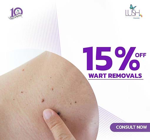 wart-removals